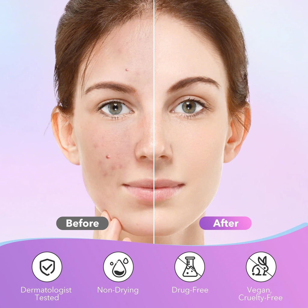 Starry Pimple Patches (280 ct) ⭐🌸 | Hydrocolloid Acne Patches for Overnight Blemish Care